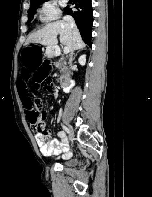 Ampullary adenocarcinoma (Radiopaedia 86093-102032 D 37).jpg