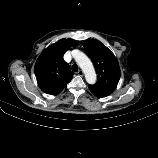 Ampullary adenocarcinoma (Radiopaedia 86093-102033 B 23).jpg