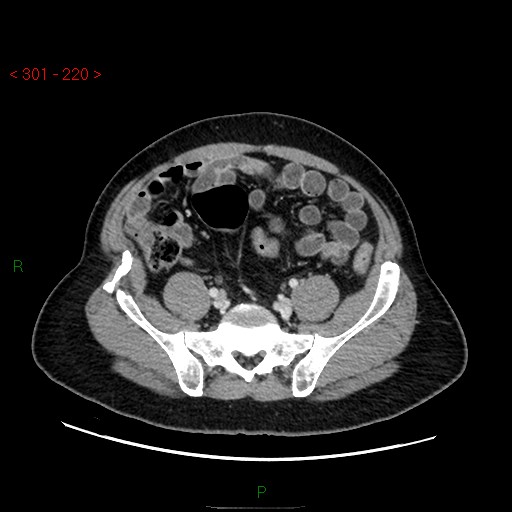 Ampullary carcinoma (Radiopaedia 56396-63056 C 74).jpg
