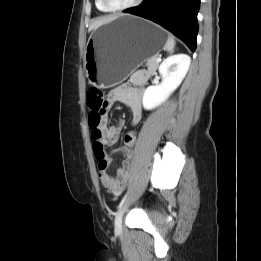 Ampullary tumor (Radiopaedia 22787-22816 D 38).jpg