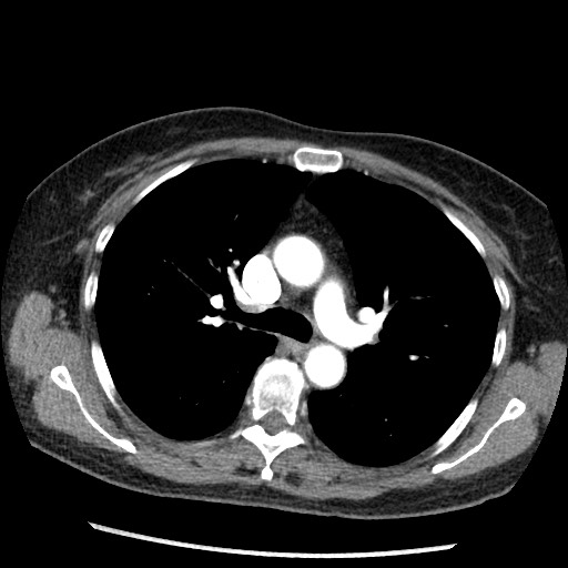 Amyloidosis - bronchial and diffuse nodular pulmonary involvement (Radiopaedia 60156-67745 A 20).jpg