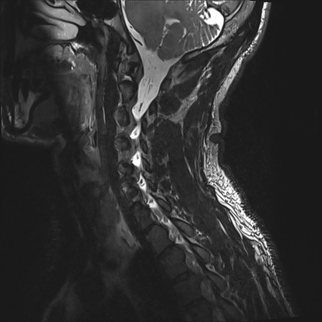 Amyotrophic lateral sclerosis (Radiopaedia 87352-103658 I 17).jpg