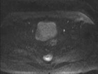 File:Anal adenocarcinoma - tumor regression grade 1 (Radiopaedia 31358-32101 Axial DWI 78).jpg