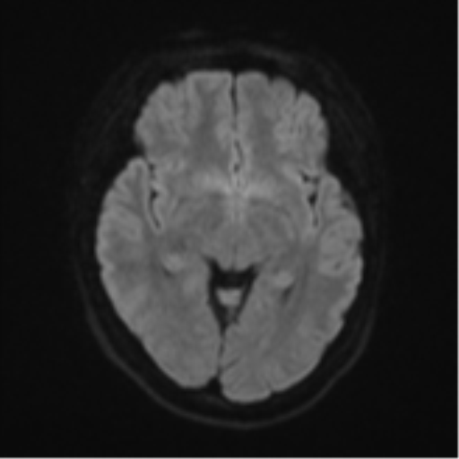 Anaplastic astroblastoma (Radiopaedia 55666-62194 Axial DWI 41).png