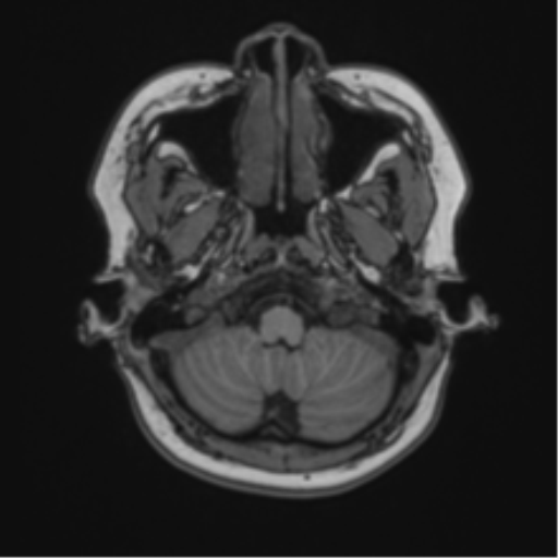 Anaplastic astroblastoma (Radiopaedia 55666-62194 Axial T1 11).png