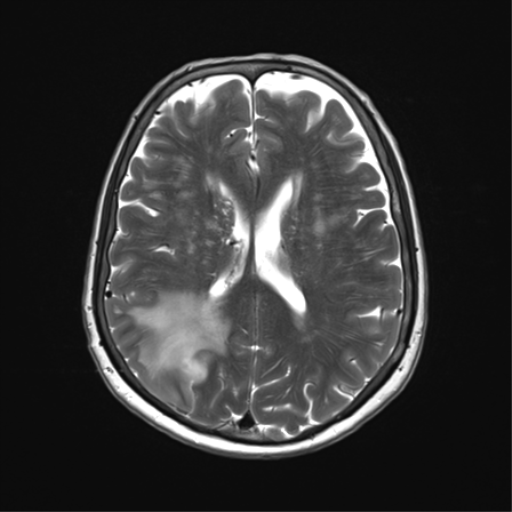 File:Anaplastic astrocytoma (Radiopaedia 86943-103160 Axial T2 24).png
