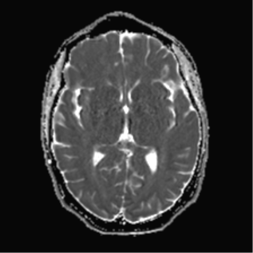File:Anaplastic astrocytoma IDH mutant (Radiopaedia 50046-55341 Axial ADC 14).png