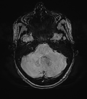 File:Anaplastic astrocytoma IDH mutant (Radiopaedia 50046-55341 Axial SWI 23).png