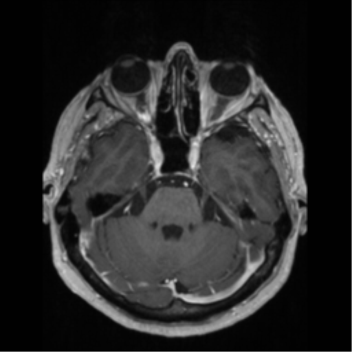 File:Anaplastic astrocytoma IDH wild-type (pseudoprogression) (Radiopaedia 42209-45276 Axial T1 C+ 50).png