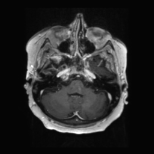 File:Anaplastic astrocytoma IDH wild-type (pseudoprogression) (Radiopaedia 42209-45279 Axial T1 C+ 35).png
