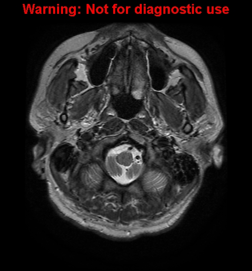 File:Anaplastic ganglioglioma (Radiopaedia 44921-48831 Axial T2 2).jpg
