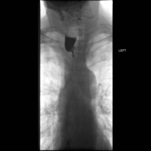 File:Anastomotic stricture post Ivor Lewis esophagectomy (Radiopaedia 47937-52715 Frontal 23).png
