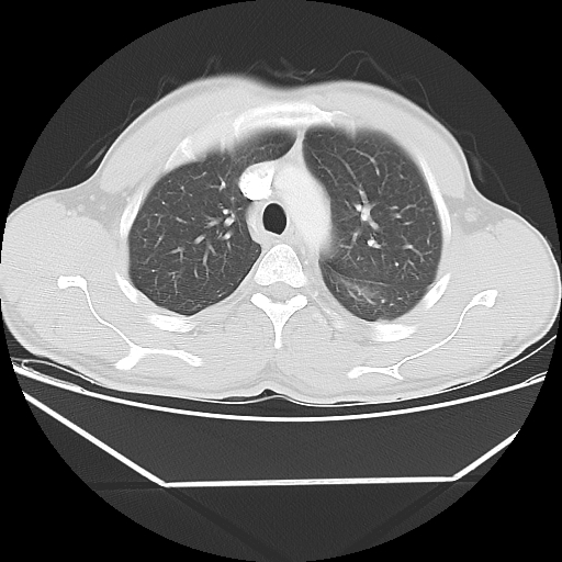 File:Aneurysmal bone cyst - rib (Radiopaedia 82167-96220 Axial lung window 24).jpg
