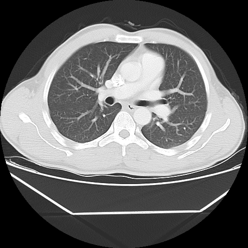 File:Aneurysmal bone cyst - rib (Radiopaedia 82167-96220 Axial lung window 32).jpg