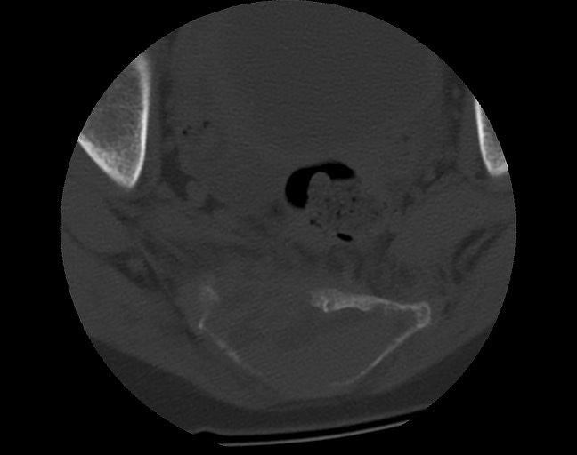 Aneurysmal bone cyst - sacrum (Radiopaedia 65190-74195 Axial bone window 34).jpg