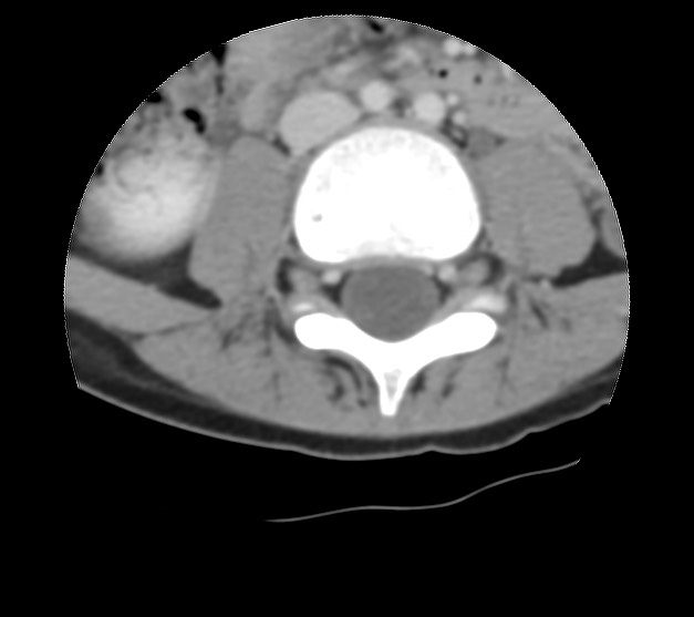 Aneurysmal bone cyst - sacrum (Radiopaedia 65190-74195 Axial non-contrast 3).jpg