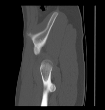 Aneurysmal bone cyst of ischium (Radiopaedia 25957-26094 Sagittal bone window 14).png
