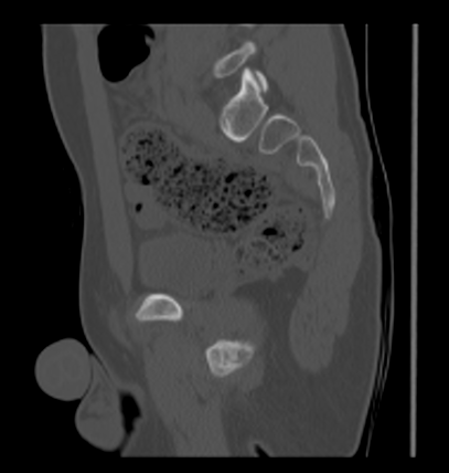 Aneurysmal bone cyst of ischium (Radiopaedia 25957-26094 Sagittal bone window 44).png