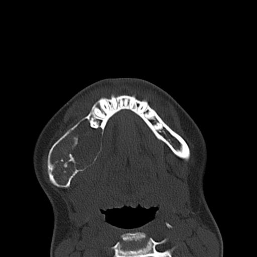 Aneurysmal bone cyst of the mandible (Radiopaedia 43280-46601 Axial bone window 15).jpg