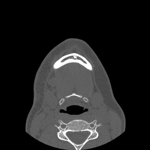 File:Aneurysmal bone cyst of the mandible (Radiopaedia 43280-46823 Axial bone window 11).jpg