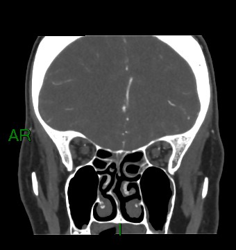 Aneurysmal subarachnoid hemorrhage with intra-axial extension (Radiopaedia 84371-99732 C 72).jpg