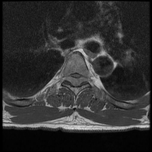 File:Angiolipoma - thoracic spine (Radiopaedia 28242-28479 Axial T1 17).jpg