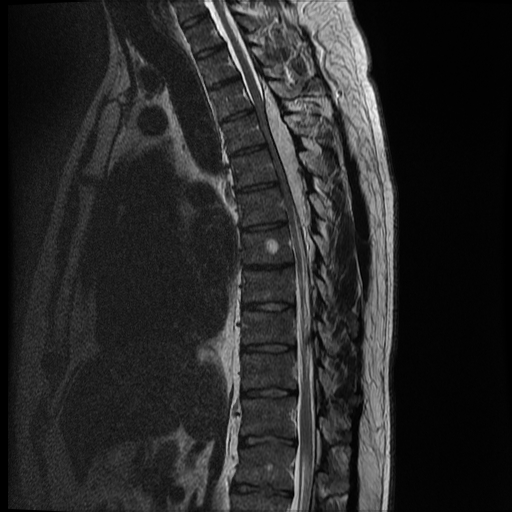 File:Angiolipoma - thoracic spine (Radiopaedia 28242-28479 Sagittal T2 7).jpg