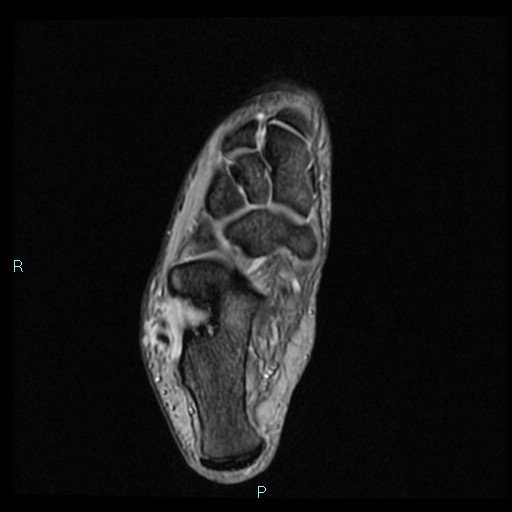 Ankle ganglion cyst (Radiopaedia 62809-71162 Axial Gradient Echo 30).jpg