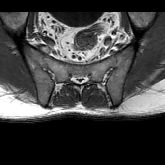 File:Ankylosing spondylitis with zygapophyseal arthritis (Radiopaedia 38433-40517 B 9).jpg