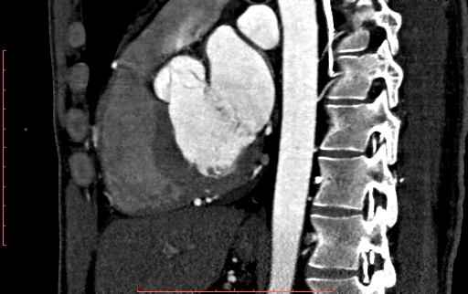Anomalous left coronary artery from the pulmonary artery (ALCAPA) (Radiopaedia 70148-80181 C 133).jpg