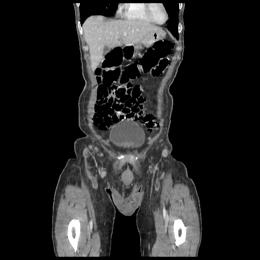 Anorectal carcinoma (Radiopaedia 44413-48064 B 5).jpg