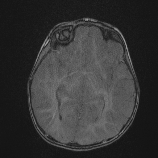 Anoxic brain injury (Radiopaedia 79165-92139 Axial MRA 113).jpg