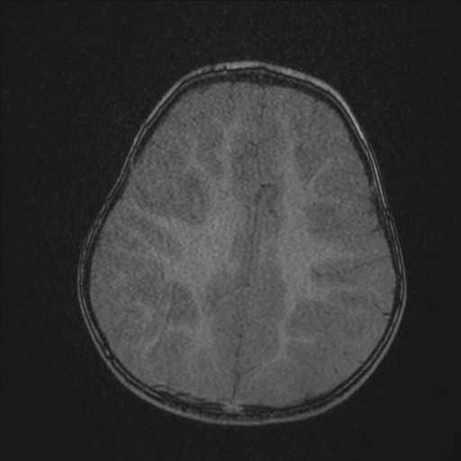 Anoxic brain injury (Radiopaedia 79165-92139 Axial MRA 183).jpg