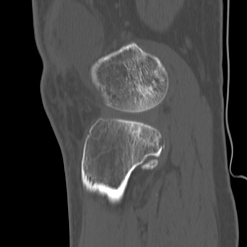 File:Anterior cruciate ligament avulsion fracture (Radiopaedia 58939-66194 Sagittal bone window 8).jpg