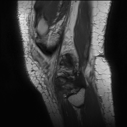 Anterior cruciate ligament rupture with Segond fracture (Radiopaedia 69043-78806 Sagittal PD 167).jpg