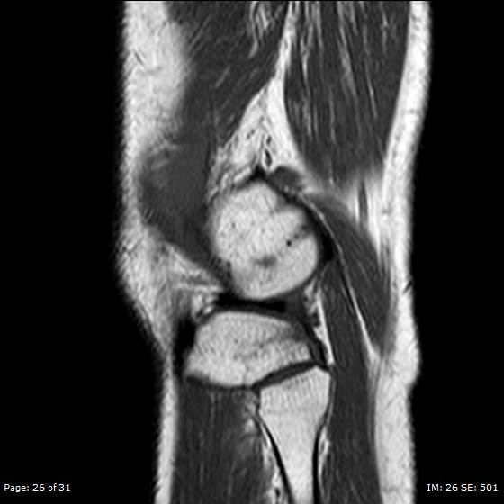 File:Anterior cruciate ligament tear (Radiopaedia 70783-80964 Sagittal T1 26).jpg