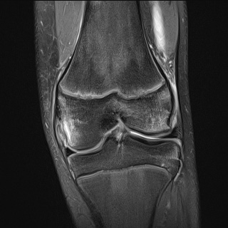 File:Anterior cruciate ligament tear - pediatric (Radiopaedia 62152-70260 Coronal PD fat sat 13).jpg