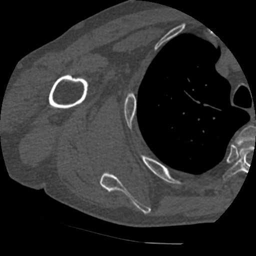 Anterior glenohumeral dislocation with Hill-Sachs lesion (Radiopaedia 62877-71249 Axial bone window 61).jpg