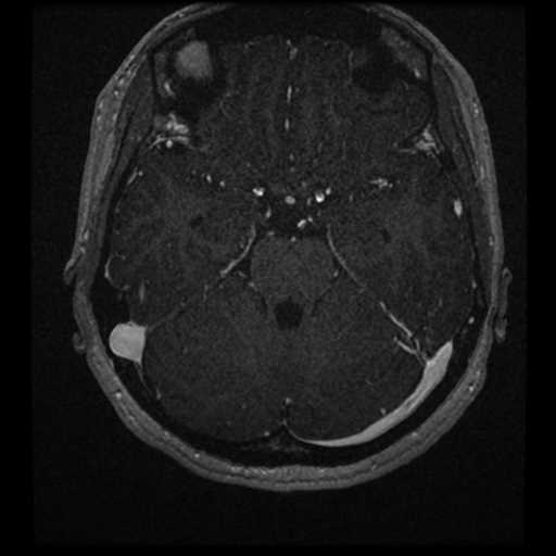Anterior inferior cerebellar artery vascular loop - type II (Radiopaedia 70991-81209 Axial T1 C+ 10).jpg