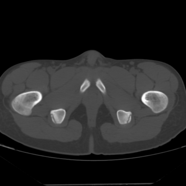 Anterior inferior iliac spine avulsion fracture (Radiopaedia 49469-54627 Axial bone window 54).jpg
