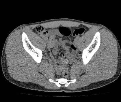 Anterior inferior iliac spine avulsion fracture (Radiopaedia 81312-94999 Axial non-contrast 40).jpg