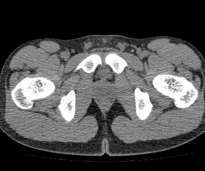 Anterior inferior iliac spine avulsion fracture (Radiopaedia 81312-94999 Axial non-contrast 63).jpg