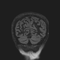 Anterior temporal encephalocele (Radiopaedia 82624-96808 Coronal FLAIR 45).jpg
