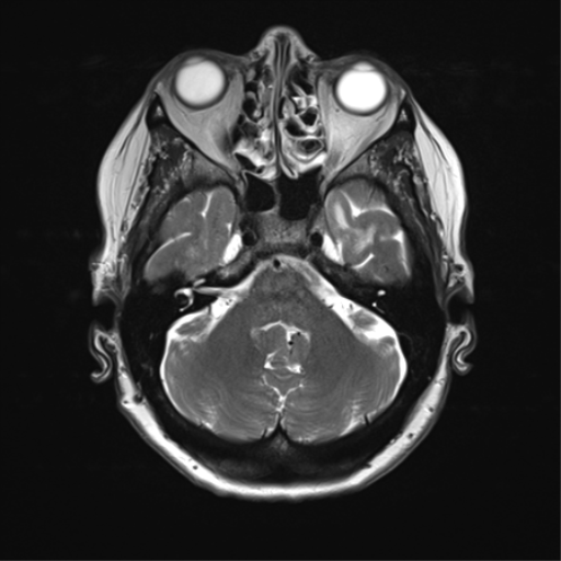File:Anterior temporal pole cysts (Radiopaedia 46629-51102 C 10).png