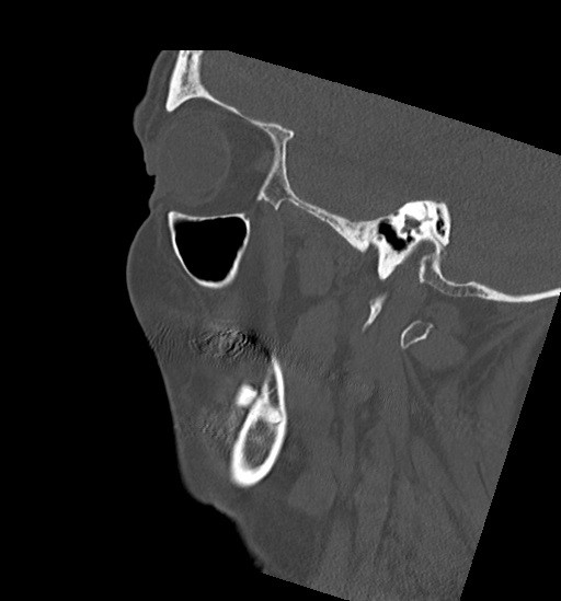 Anterior temporomandibular joint dislocation (Radiopaedia 59430-66784 B 15).jpg
