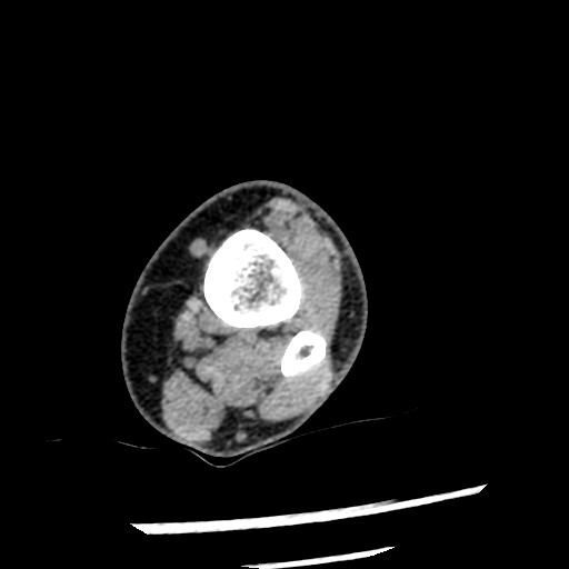 Anterior tibial artery false aneurysm (Radiopaedia 88984-105809 A 57).jpg