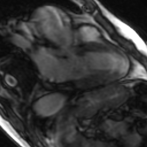 File:Anteroseptal hypokinesia after myocardial infarction (Radiopaedia 15978-15633 3 chamber view SSFE 25).jpg
