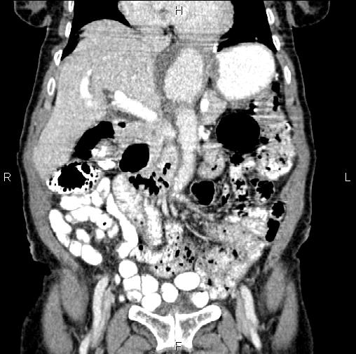 Aortic aneurysm and Lemmel syndrome (Radiopaedia 86499-102554 C 22).jpg