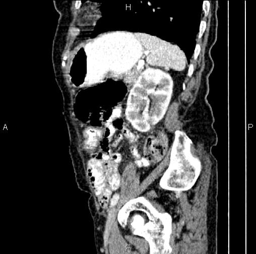 Aortic aneurysm and Lemmel syndrome (Radiopaedia 86499-102554 D 67).jpg
