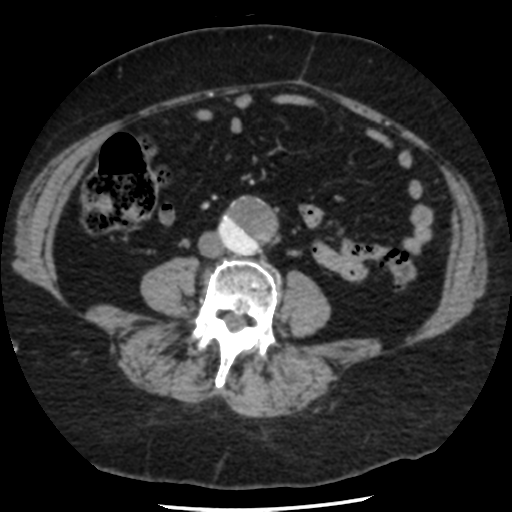 File:Aortic aneurysm and dissection - Stanford type A (Radiopaedia 36693-38261 A 71).png